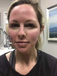 HALO LASER experience by popular Nashville beauty blogger, Nashville Wifestyles | I am 34 years old and have never had a laser until this year. It’s time, the sun has had its way with me and now I have to do whatever I can to reduce the damage. I've been intrigued by lasers for a while. After a few friends tried them, I decided to jump in. I am all for having nothing done and aging with grace. Click to read about how I am invested in taking care of my skin and my halo laser experience. We'll also discuss if the price is worth it. #laser #skincare