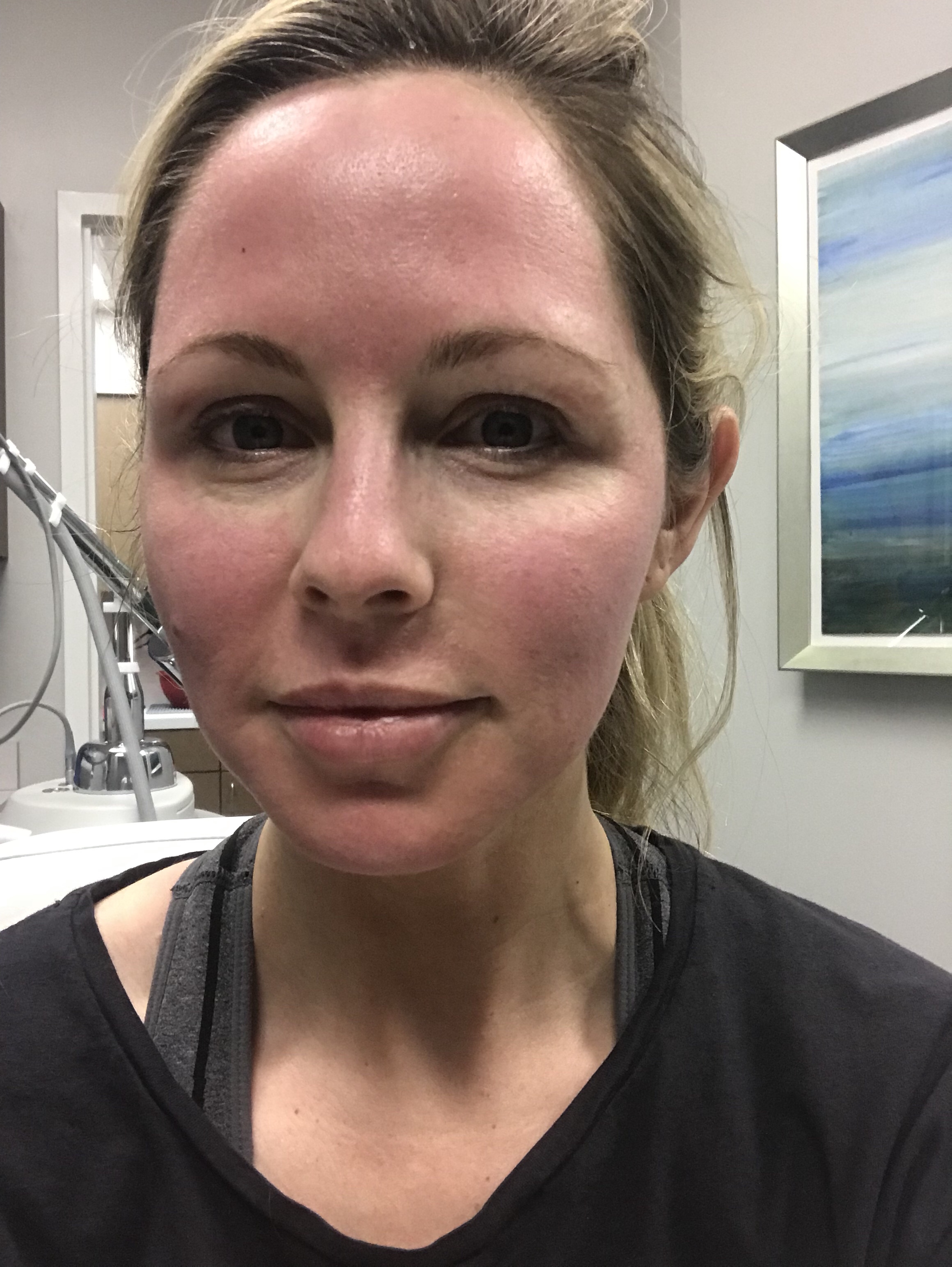 HALO LASER experience by popular Nashville beauty blogger, Nashville Wifestyles | I am 34 years old and have never had a laser until this year. It’s time, the sun has had its way with me and now I have to do whatever I can to reduce the damage. I've been intrigued by lasers for a while. After a few friends tried them, I decided to jump in. I am all for having nothing done and aging with grace. Click to read about how I am invested in taking care of my skin and my halo laser experience. We'll also discuss if the price is worth it. #laser #skincare