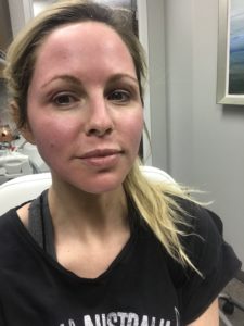 HALO LASER experience by popular Nashville beauty blogger, Nashville Wifestyles | I am 34 years old and have never had a laser until this year. It’s time, the sun has had its way with me and now I have to do whatever I can to reduce the damage. I've been intrigued by lasers for a while. After a few friends tried them, I decided to jump in. I am all for having nothing done and aging with grace. Click to read about how I am invested in taking care of my skin and my halo laser experience. We'll also discuss if the price is worth it. #laser #skincare