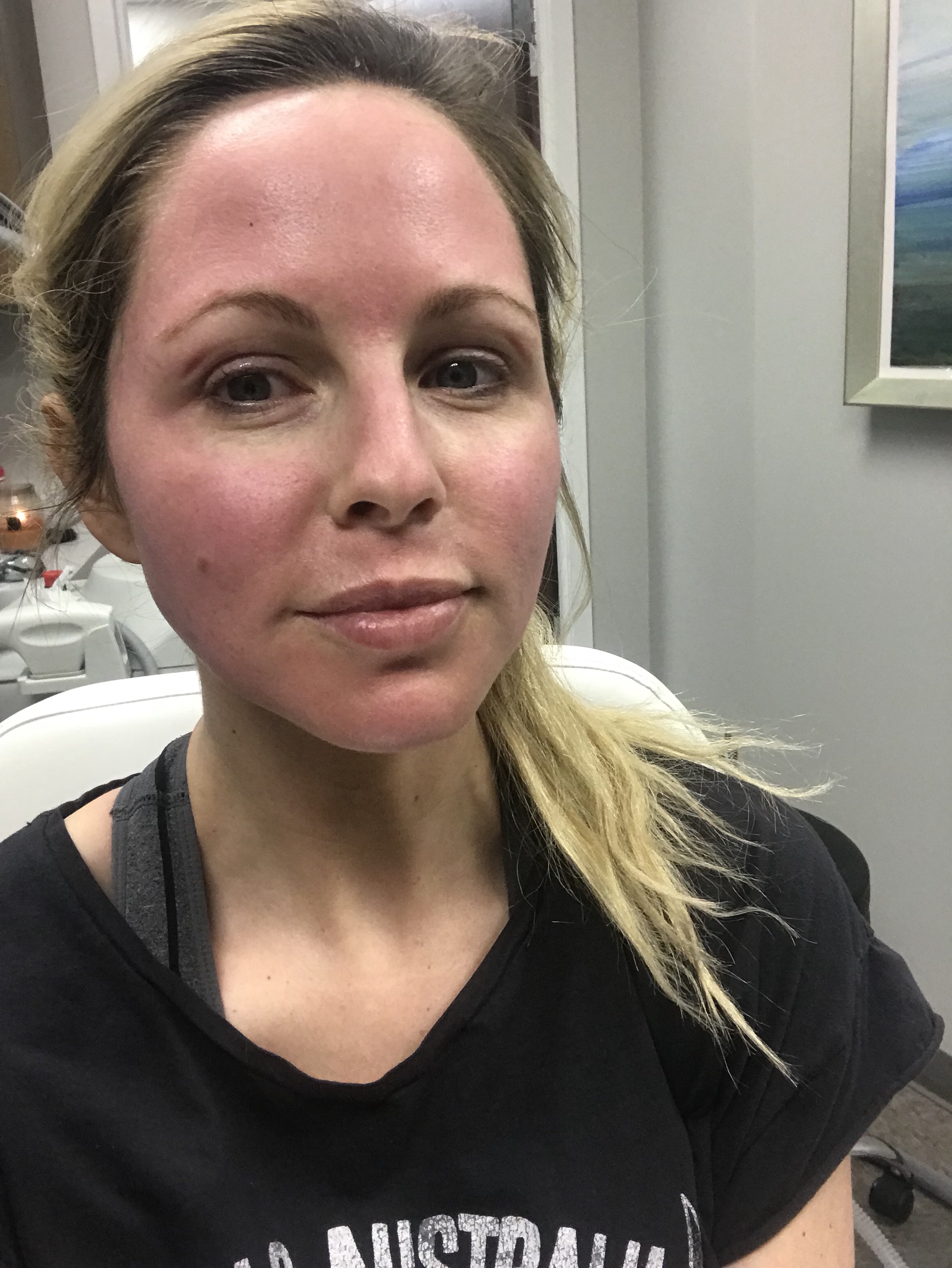 HALO LASER experience by popular Nashville beauty blogger, Nashville Wifestyles | I am 34 years old and have never had a laser until this year. It’s time, the sun has had its way with me and now I have to do whatever I can to reduce the damage. I've been intrigued by lasers for a while. After a few friends tried them, I decided to jump in. I am all for having nothing done and aging with grace. Click to read about how I am invested in taking care of my skin and my halo laser experience. We'll also discuss if the price is worth it. #laser #skincare
