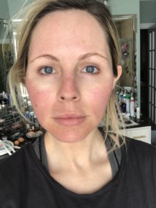 HALO LASER experience by popular Nashville beauty blogger, Nashville Wifestyles | I am 34 years old and have never had a laser until this year. It’s time, the sun has had its way with me and now I have to do whatever I can to reduce the damage. I've been intrigued by lasers for a while. After a few friends tried them, I decided to jump in. I am all for having nothing done and aging with grace. Click to read about how I am invested in taking care of my skin and my halo laser experience. We'll also discuss if the price is worth it. #laser #skincare