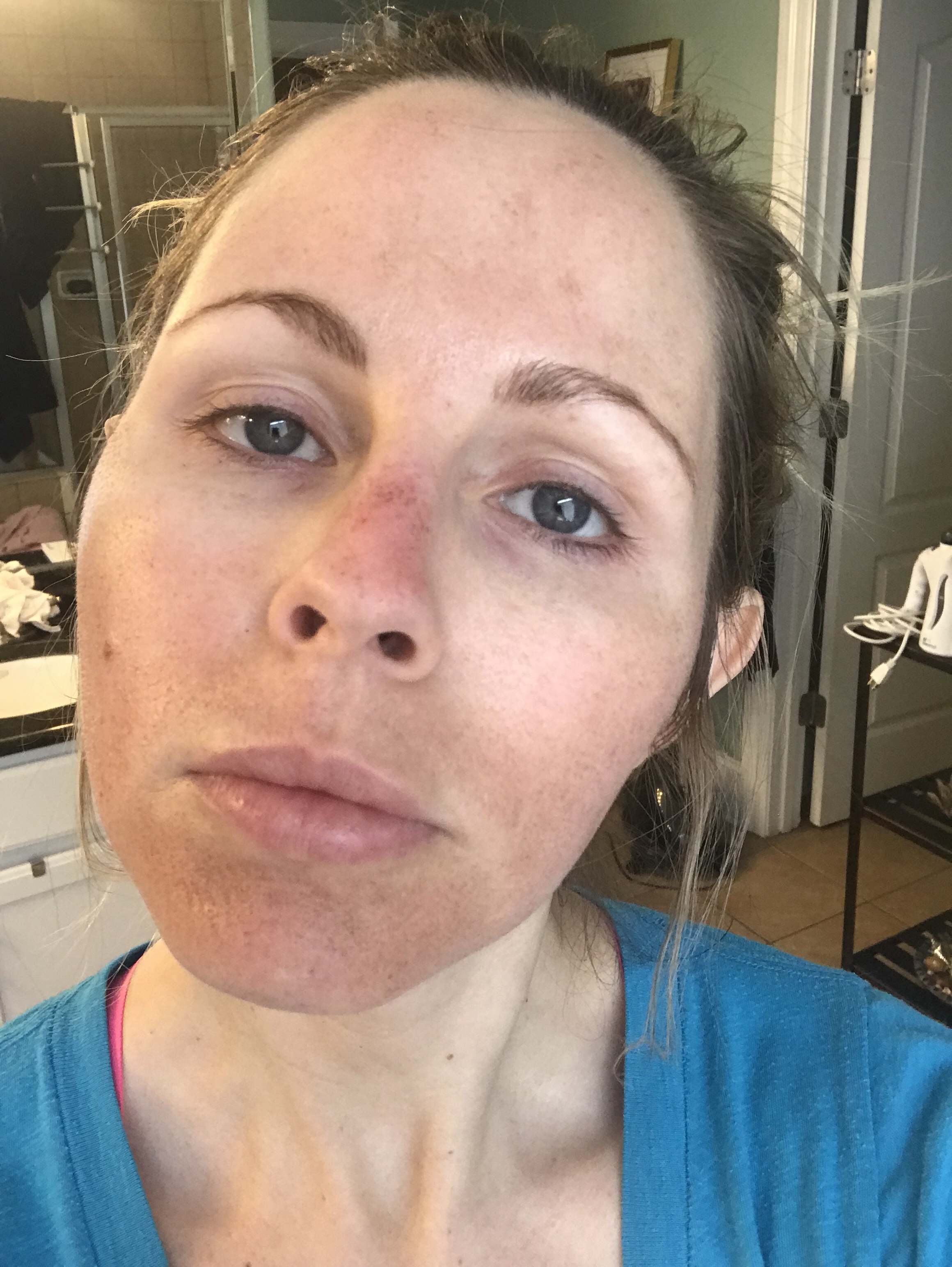 HALO LASER experience by popular Nashville beauty blogger, Nashville Wifestyles | I am 34 years old and have never had a laser until this year. It’s time, the sun has had its way with me and now I have to do whatever I can to reduce the damage. I've been intrigued by lasers for a while. After a few friends tried them, I decided to jump in. I am all for having nothing done and aging with grace. Click to read about how I am invested in taking care of my skin and my halo laser experience. We'll also discuss if the price is worth it. #laser #skincare