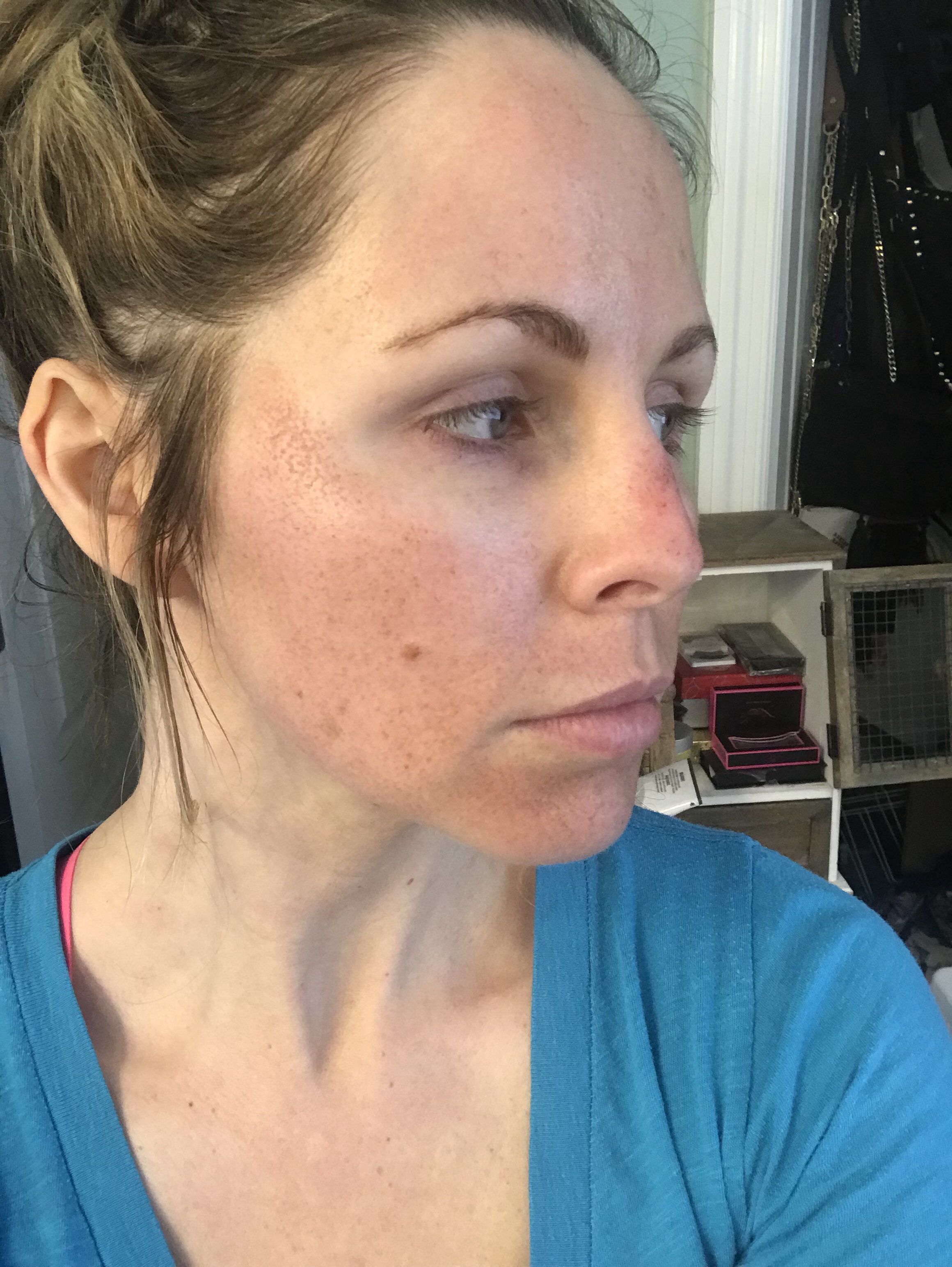 HALO LASER experience by popular Nashville beauty blogger, Nashville Wifestyles | I am 34 years old and have never had a laser until this year. It’s time, the sun has had its way with me and now I have to do whatever I can to reduce the damage. I've been intrigued by lasers for a while. After a few friends tried them, I decided to jump in. I am all for having nothing done and aging with grace. Click to read about how I am invested in taking care of my skin and my halo laser experience. We'll also discuss if the price is worth it. #laser #skincare