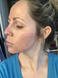 HALO LASER experience by popular Nashville beauty blogger, Nashville Wifestyles | I am 34 years old and have never had a laser until this year. It’s time, the sun has had its way with me and now I have to do whatever I can to reduce the damage. I've been intrigued by lasers for a while. After a few friends tried them, I decided to jump in. I am all for having nothing done and aging with grace. Click to read about how I am invested in taking care of my skin and my halo laser experience. We'll also discuss if the price is worth it. #laser #skincare