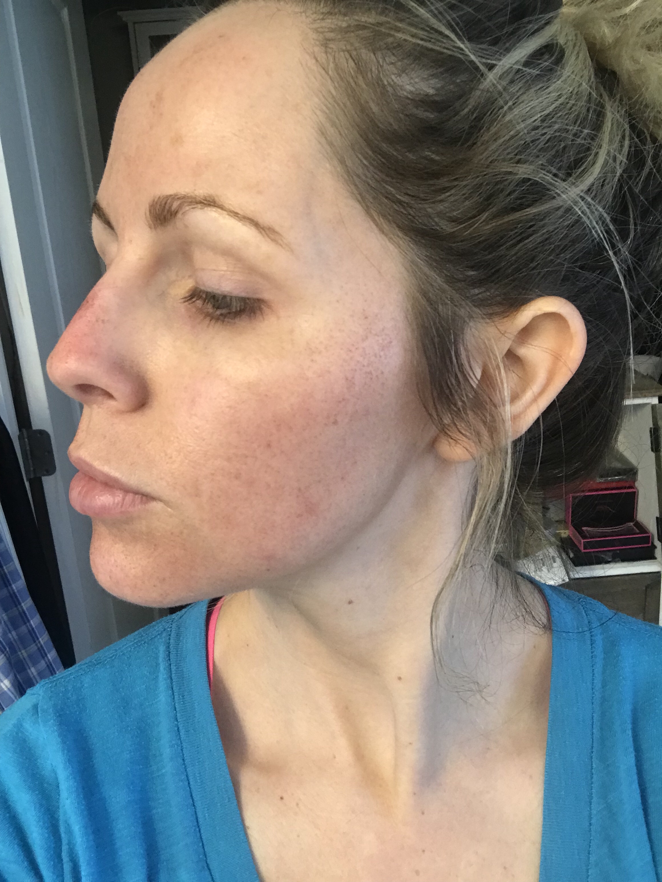 HALO LASER experience by popular Nashville beauty blogger, Nashville Wifestyles | I am 34 years old and have never had a laser until this year. It’s time, the sun has had its way with me and now I have to do whatever I can to reduce the damage. I've been intrigued by lasers for a while. After a few friends tried them, I decided to jump in. I am all for having nothing done and aging with grace. Click to read about how I am invested in taking care of my skin and my halo laser experience. We'll also discuss if the price is worth it. #laser #skincare