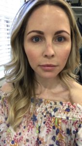 HALO LASER experience by popular Nashville beauty blogger, Nashville Wifestyles | I am 34 years old and have never had a laser until this year. It’s time, the sun has had its way with me and now I have to do whatever I can to reduce the damage. I've been intrigued by lasers for a while. After a few friends tried them, I decided to jump in. I am all for having nothing done and aging with grace. Click to read about how I am invested in taking care of my skin and my halo laser experience. We'll also discuss if the price is worth it. #laser #skincare