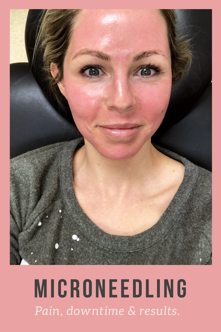 microneedling experience